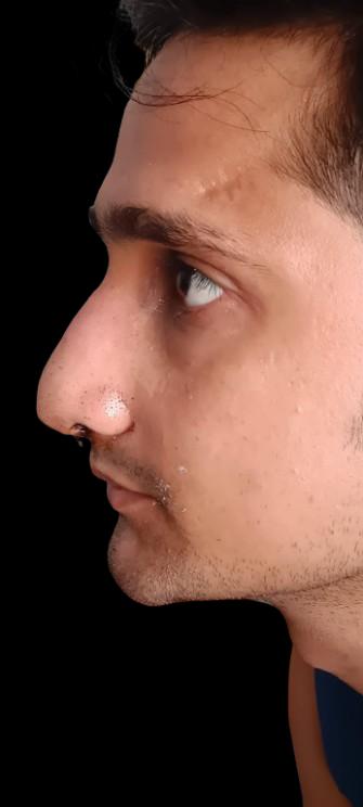 Patient profile after rhinoplasty