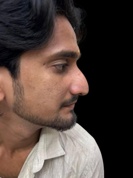 Patient profile before rhinoplasty