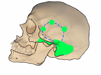 Skull base surgery