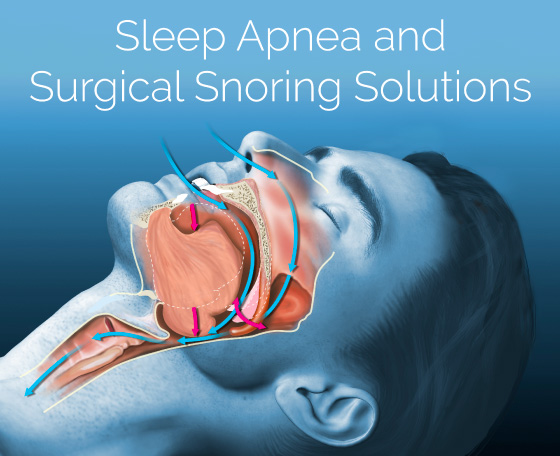 SURGERY FOR SLEEP APNEA