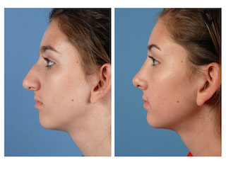 RHINOPLASTY