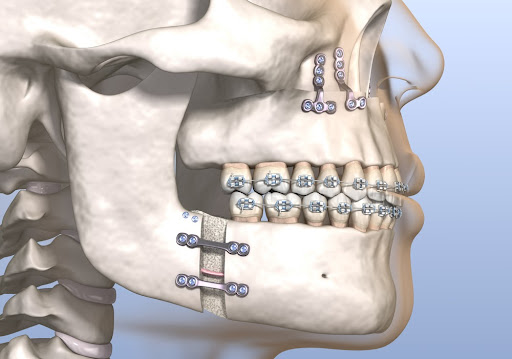 MAXILLO MANDIBULAR SURGERY