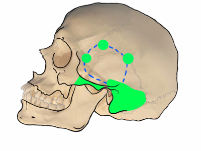 ENDOSCOPIC SKULLBASE SURGERY