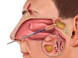 ENDOSCOPIC CSF LEAK