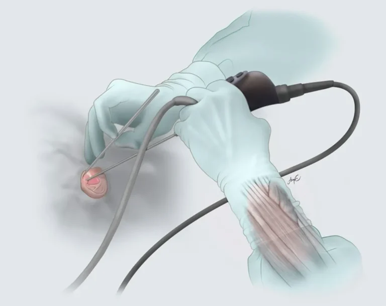 ENDOSCOPIC EAR SURGERY